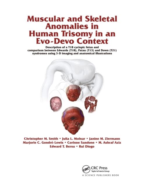 Muscular and Skeletal Anomalies in Human Trisomy in an Evo-Devo Context : Description of a T18 Cyclopic Fetus and Comparison Between Edwards (T18), Patau (T13) and Down (T21) Syndromes Using 3-D Imaging and Anatomical Illustrations