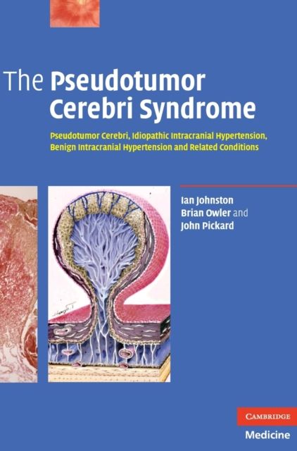 The Pseudotumor Cerebri Syndrome : Pseudotumor Cerebri, Idiopathic Intracranial Hypertension, Benign Intracranial Hypertension and Related Conditions
