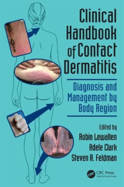 Clinical Handbook of Contact Dermatitis : Diagnosis and Management by Body Region