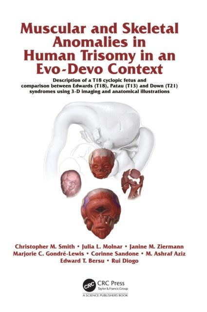 Muscular and Skeletal Anomalies in Human Trisomy in an Evo-Devo Context : Description of a T18 Cyclopic Fetus and Comparison Between Edwards (T18), Patau (T13) and Down (T21) Syndromes Using 3-D Imaging and Anatomical Illustrations