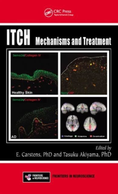 Itch : Mechanisms and Treatment