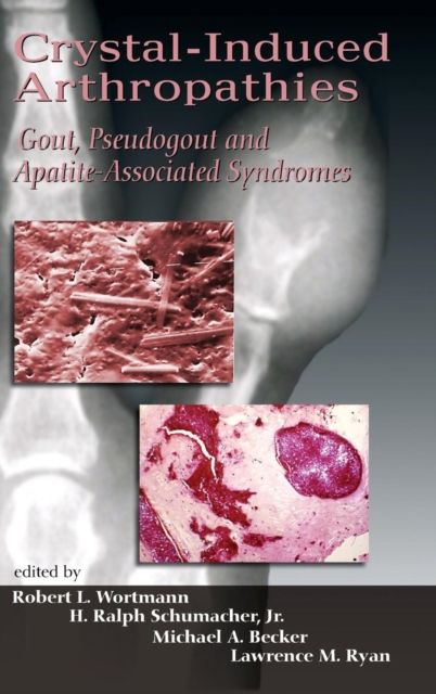 Crystal-Induced Arthropathies : Gout, Pseudogout and Apatite-Associated Syndromes
