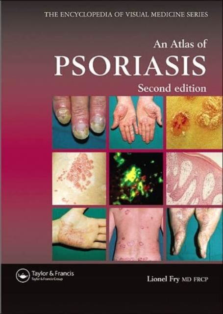 An Atlas of Psoriasis, Second Edition