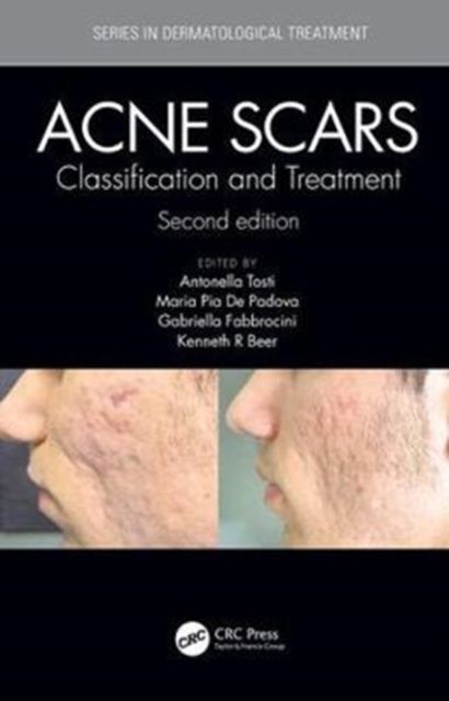 Acne Scars : Classification and Treatment, Second Edition